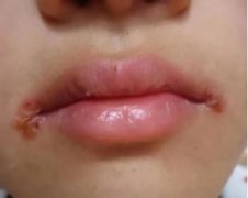 口角炎究竟是怎么回事呢?都是什么原因造成的？