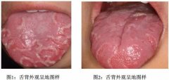 小舌头，大学问，得了“地图舌”怎么办？