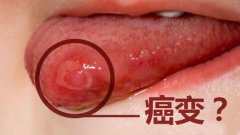 这些口腔黏膜病需注意！