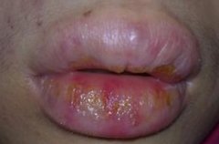 嘴唇干裂、脱皮 还痒痒的？可能是慢性唇炎